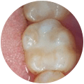 Cosmetic Fillings