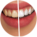 Teeth Whitening