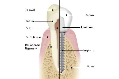 Dental Implants Dental Implants