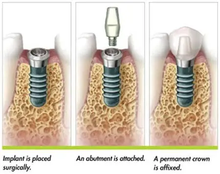 Titanium dental implants Titanium dental implants by Fendalton Dental