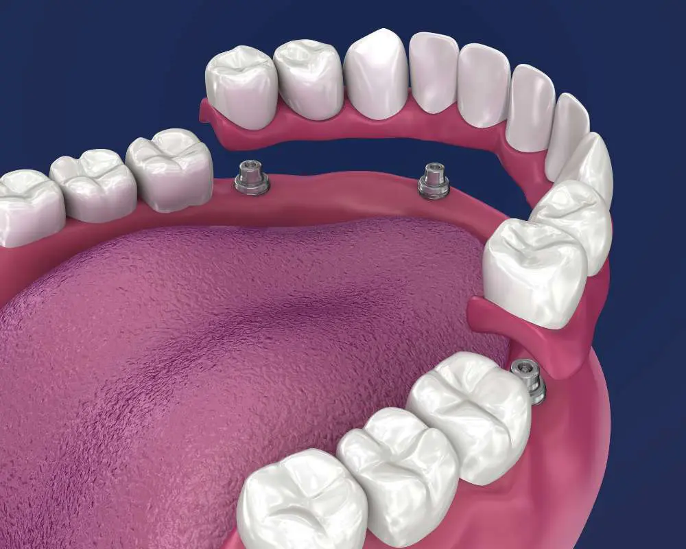 Implant dentures Implant dentures such as All-on-4