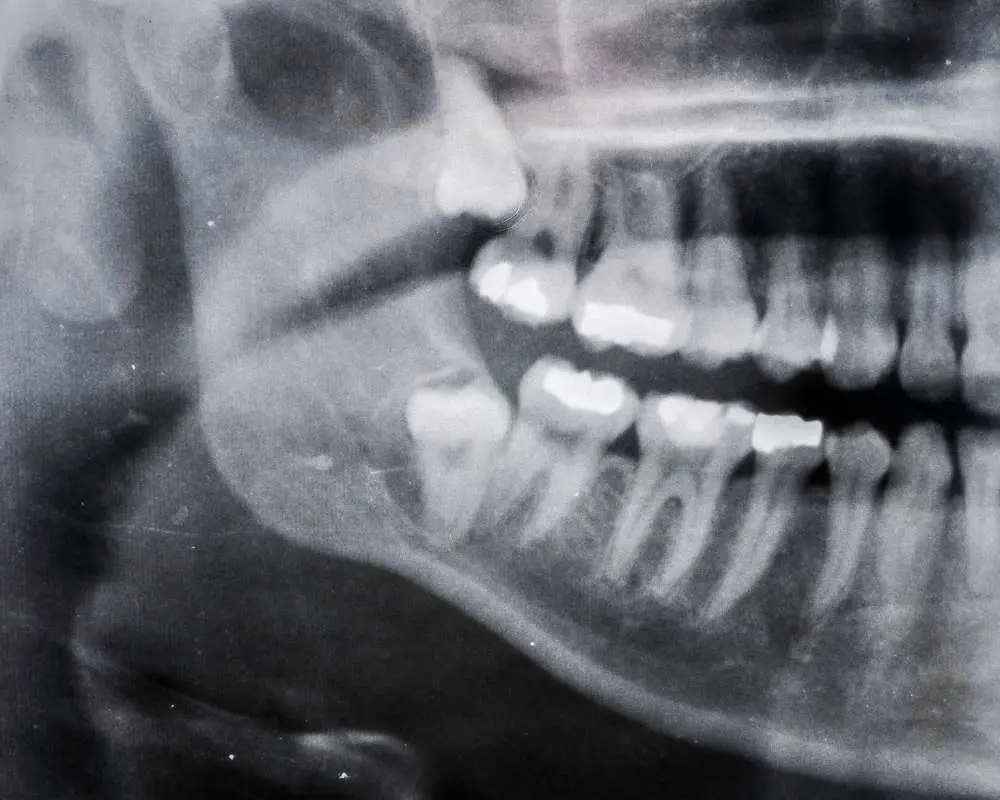 wisdom teeth removal