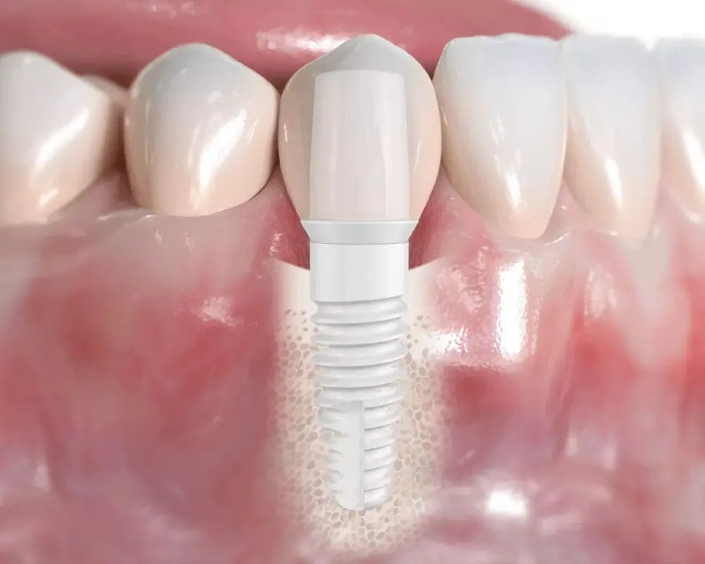 Zirconia implants holistic dentistry Zirconia implants holistic dentistry