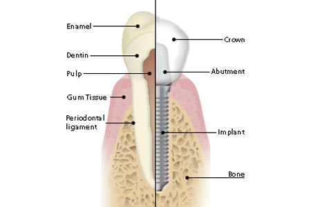 Dental Implants Dental Implants