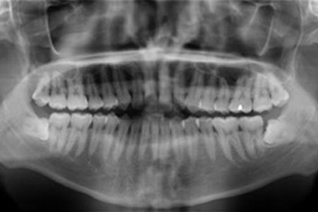 Digital X-Rays of teeth