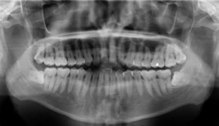 Digital x-rays for better photos of your teeth
