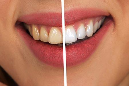 Hygienist Services Teeth cleaning and whitening with our Hygienist Services