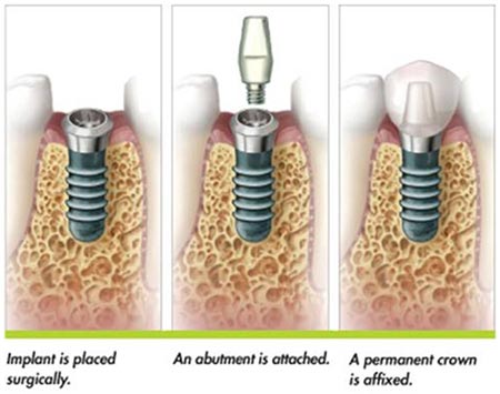 Titanium dental implants by Fendalton Dental