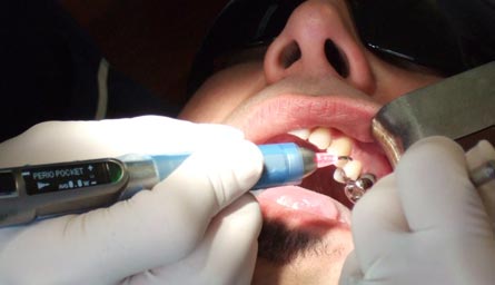 Epic 10 for surgery, pain relief and teeth whitening