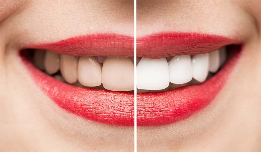 Laser teeth whitening with Fendalton Dental