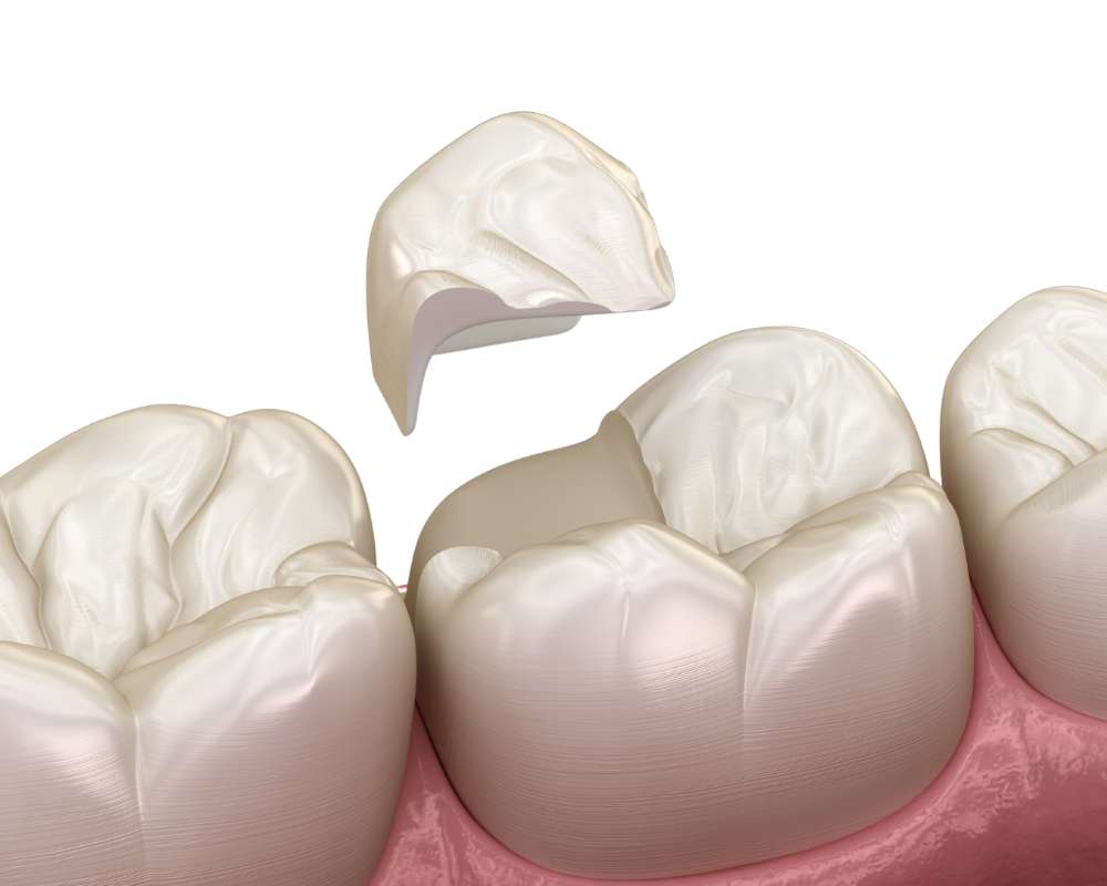 Get Porcelain crowns - tooth-coloured caps for your teeth in Christchurch